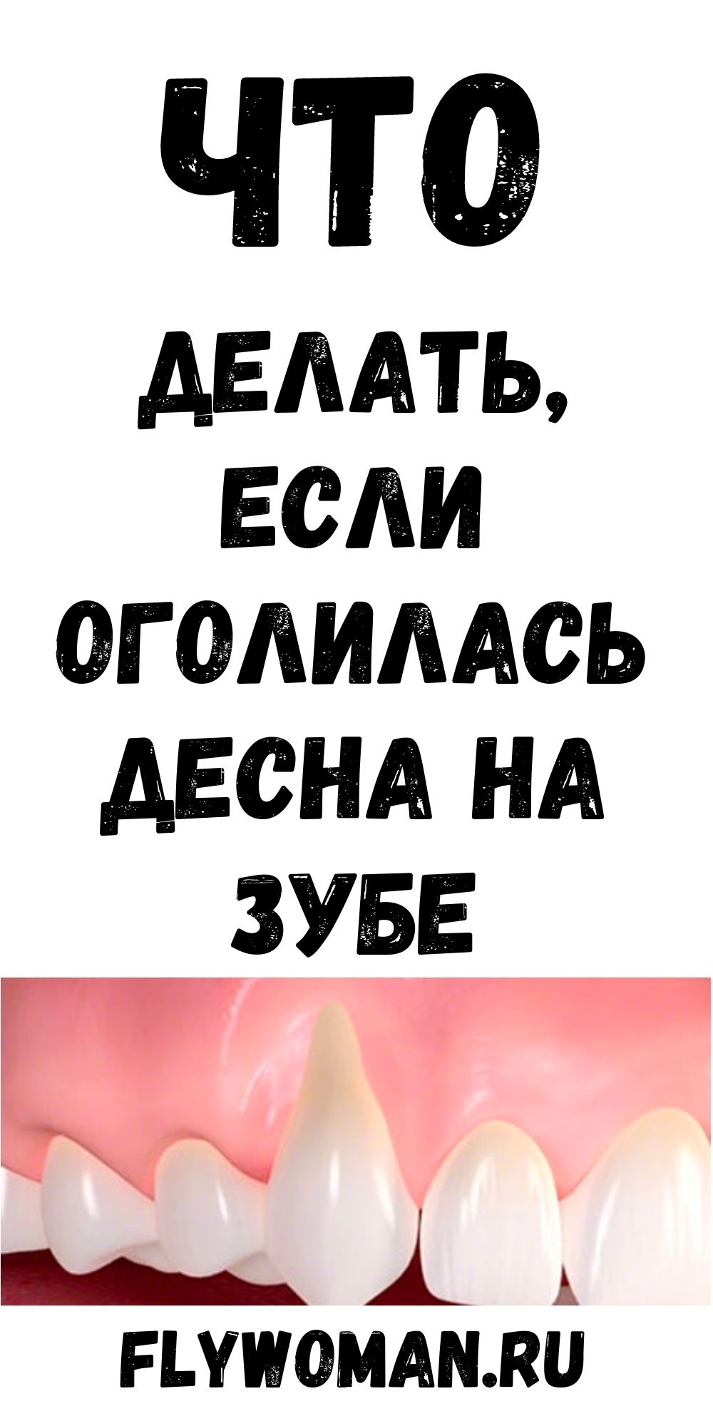 Что нужно делать, чтобы вернуть оголившую десну зуба на место? Что нужно делать, чтобы вернуть оголившую десну зуба на место?