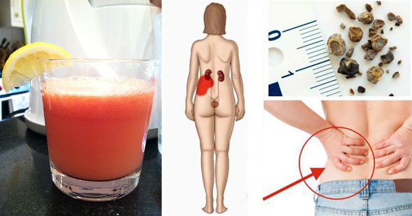 Как приготовить самый мощный сок, который естественным образом удаляет камни в почках и желчные камни! Как приготовить самый мощный сок, который естественным образом удаляет камни в почках и желчные камни!