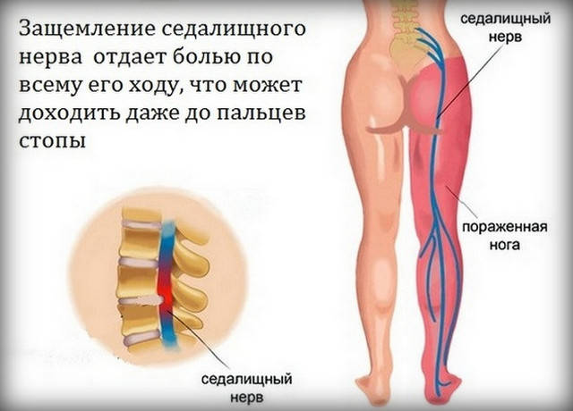 Ишиас. Что делать в случае защемления седалищного нерва? Как справиться с болью? Ишиас. Что делать в случае защемления седалищного нерва? Как справиться с болью?