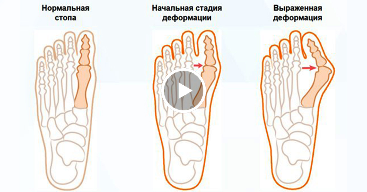 Как Бороться С Косточками На Ногах?! Защитите Своё Здоровье! Как Бороться С Косточками На Ногах?! Защитите Своё Здоровье!